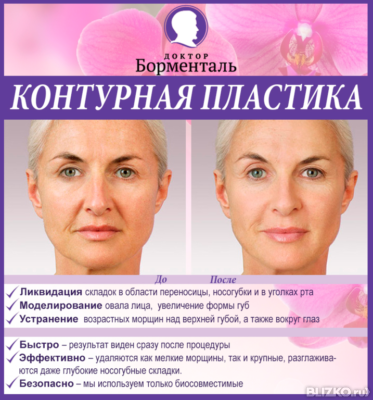 Пластика лица мезонитями Пластика лица мезонитями