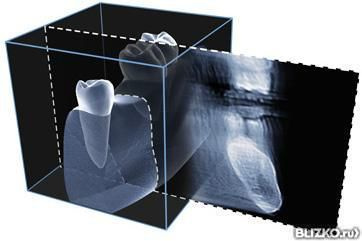Компьютерная томография челюстно-лицевой области сектор 5Х5,5